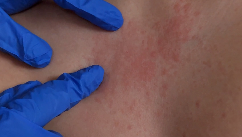 Alerta por Brote de Sarampión: Riesgo Comunitario en Mexicali