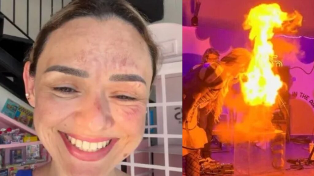Accidente del Influencer Arlen Hernández: Rostro Quemado por un Pastel Explosivo