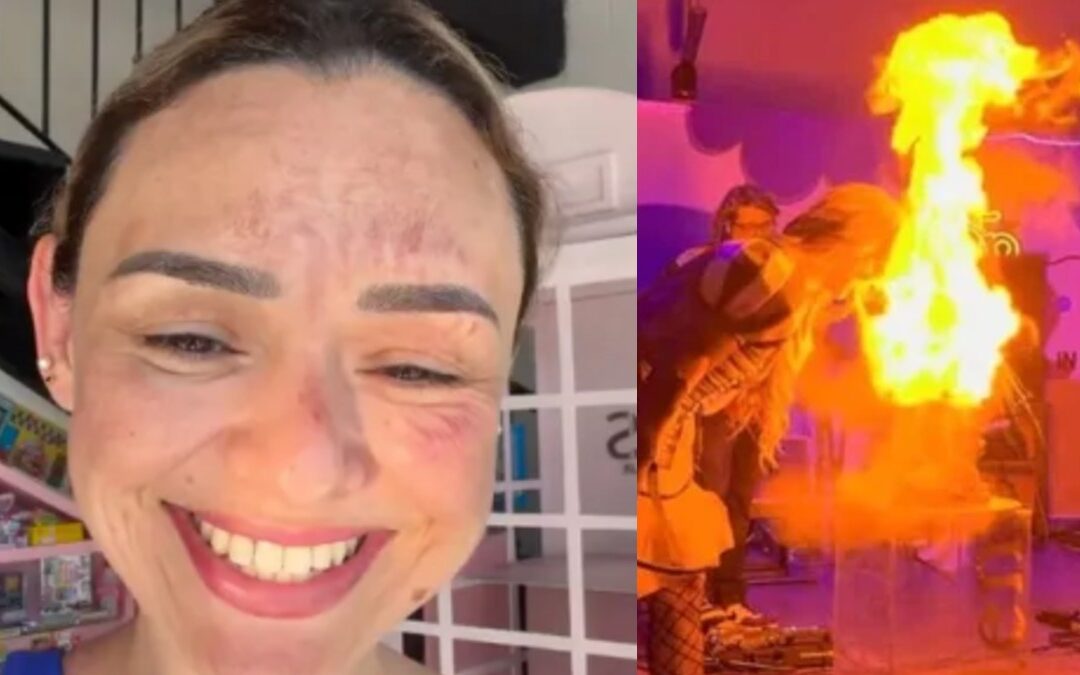 Accidente del Influencer Arlen Hernández: Rostro Quemado por un Pastel Explosivo