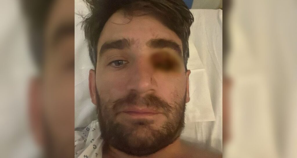 Explosión de Fuego Pirotécnico en Fiesta de Año Nuevo Deja a Hombre Sin Ojo