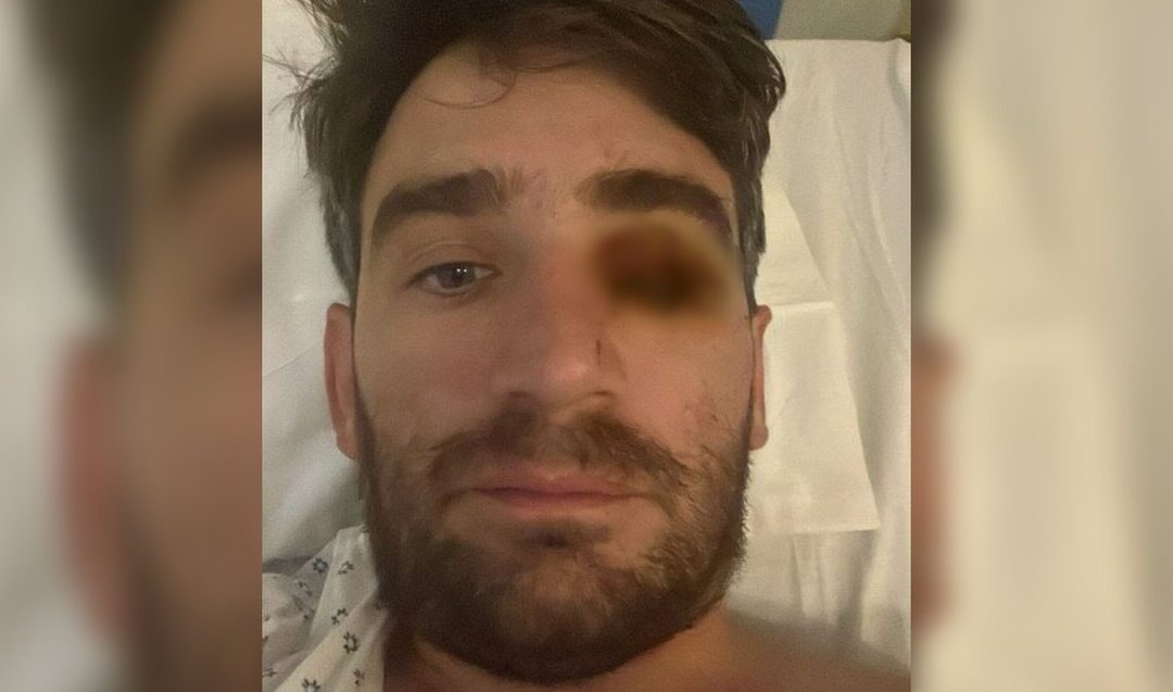 Explosión de Fuego Pirotécnico en Fiesta de Año Nuevo Deja a Hombre Sin Ojo